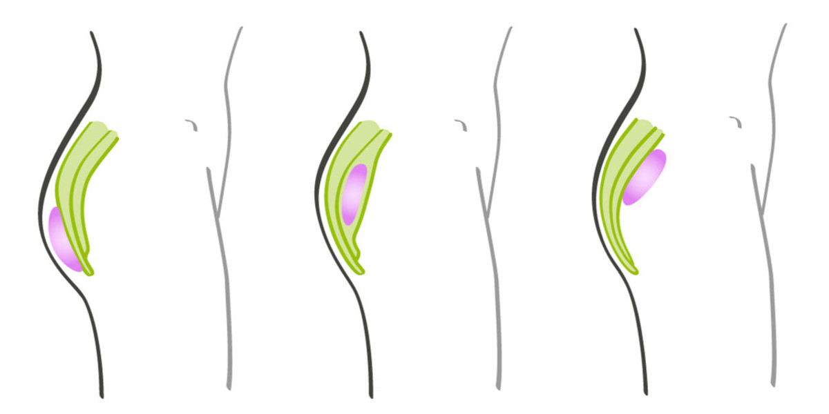 Po Vergrößerung Implantate beim Spezialisten in München